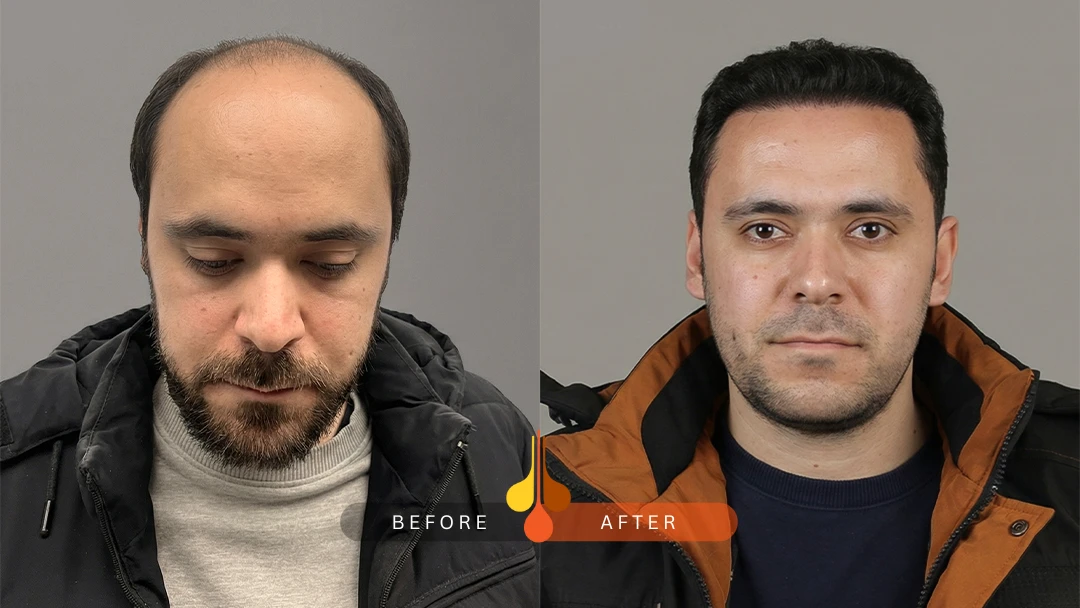 نمونه کاشت مو در کلینیک فخرائی