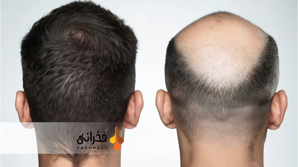 تاثیر بانک مو بر انتخاب روش کاشت