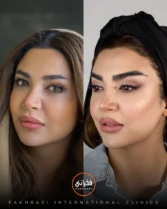 کاشت مو کلینیک فخرایی به روش ntf