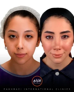 کاشت مو کلینیک فخرایی به روش ntf