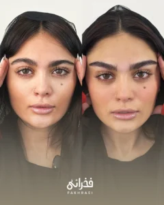 کاشت مو کلینیک فخرایی به روش ntf 