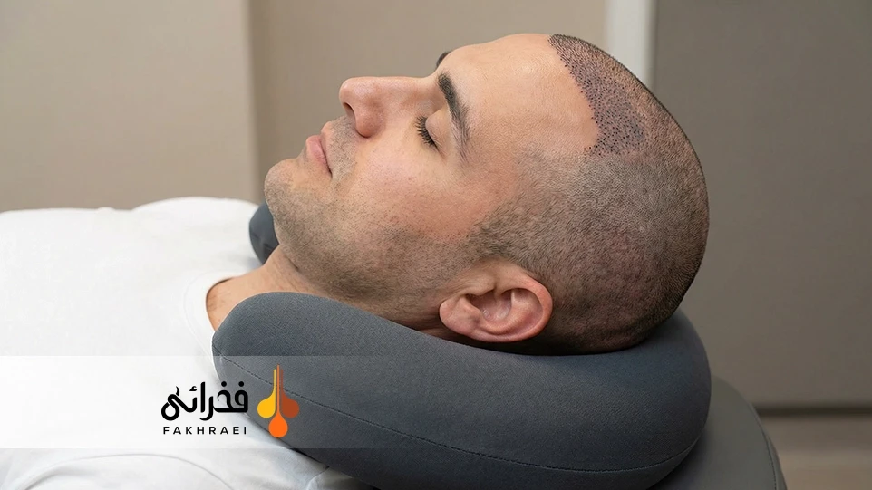 نحوه خوابیدن بعد از کاشت مو 